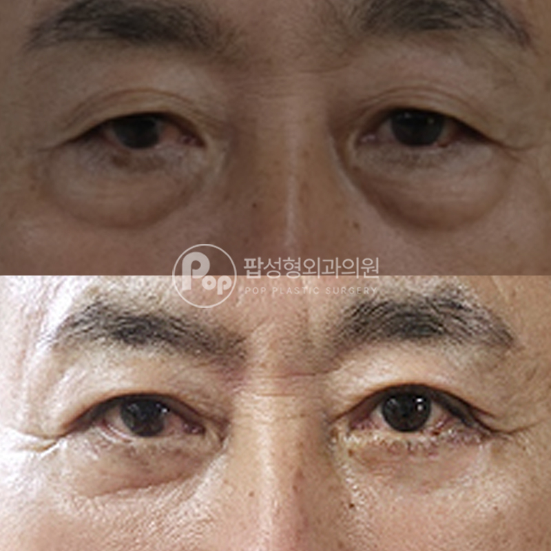팝성형외과 60대  상안검 하안검 2주차 후기