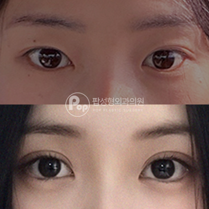 팝성형외과 눈재수술 2주차 후기