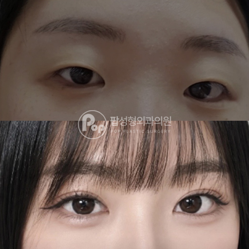 팝성형외과 세미아웃라인 자연유착 매몰 눈매교정 후기