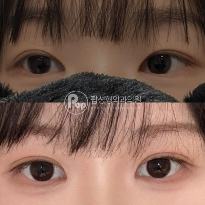팝성형외과 자연유착 눈성형 사후관리 후기