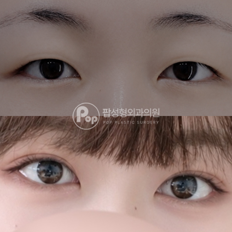 팝성형외과 무쌍 자연유착 트임 눈매교정 후기