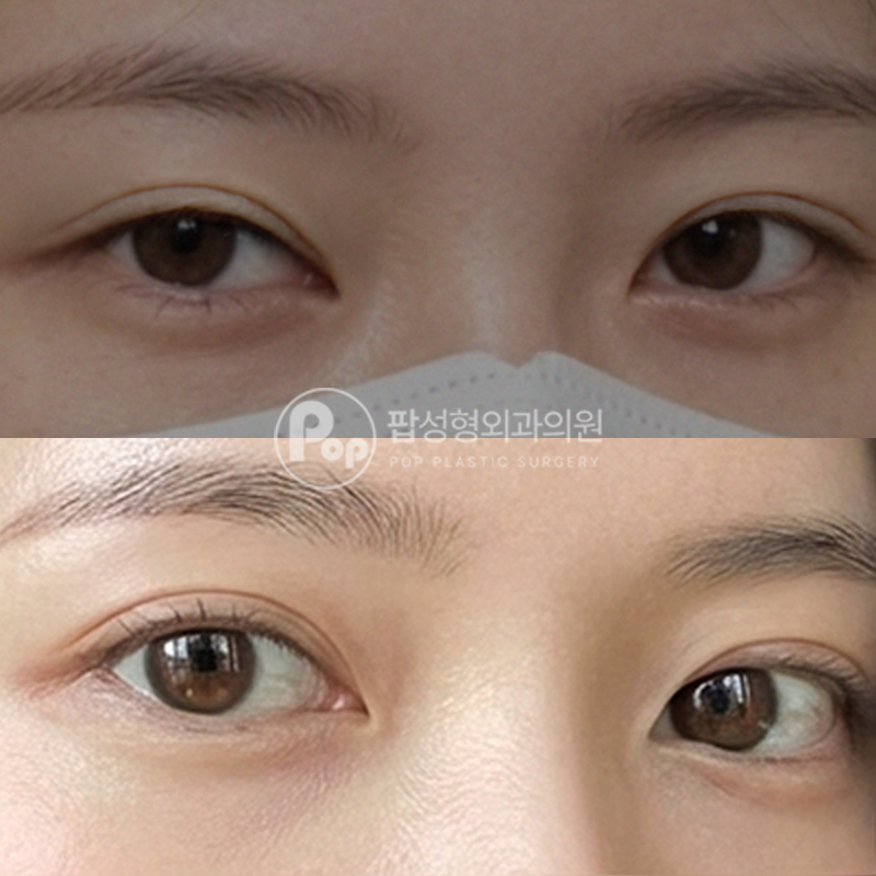 팝성형외과 소세지라인에서 인아웃 눈재수술 후기