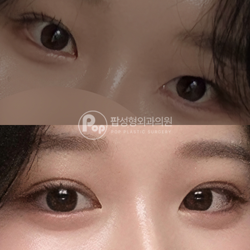 팝성형외과 풀린 눈 자연유착 눈재수술 후기