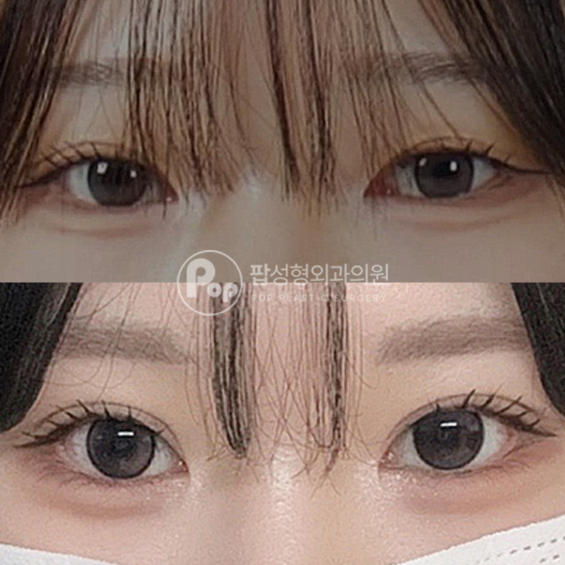 팝성형외과 세미아웃 눈재수술 후기