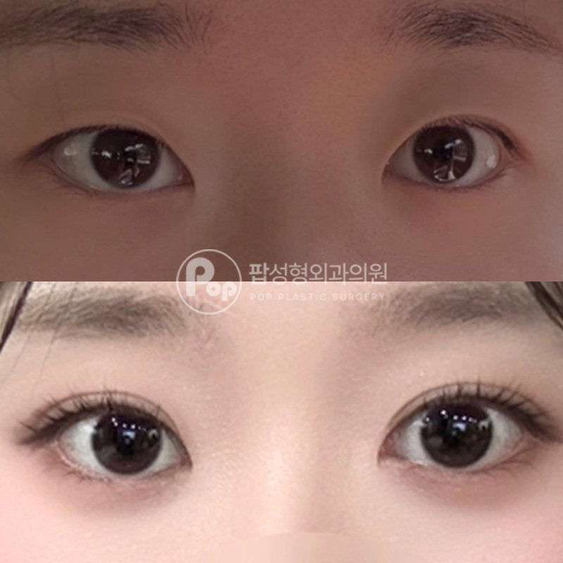 팝성형외과 세미아웃라인 눈재수술 리뷰