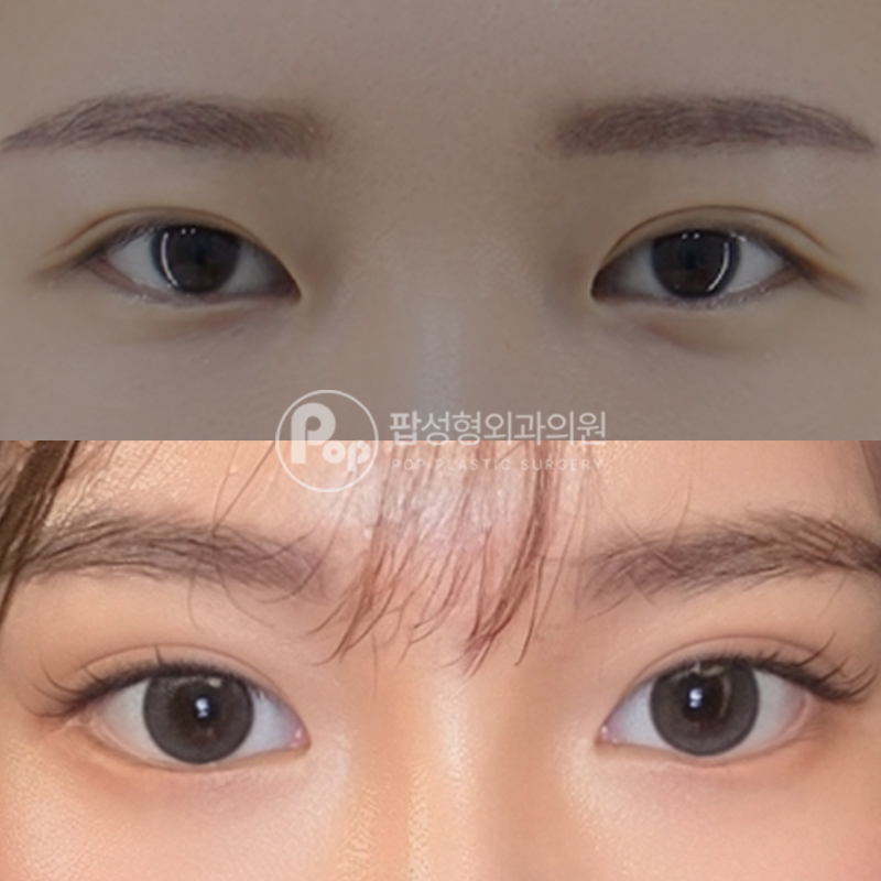 팝성형외과 짝눈 눈재수술 눈성형 후기