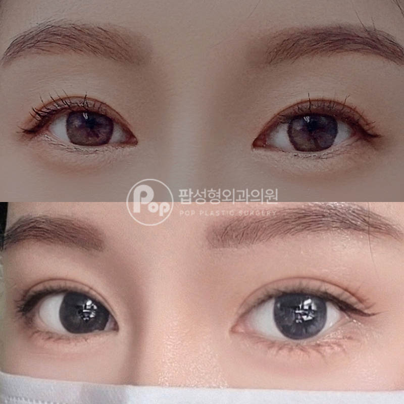팝성형외과 풀린 라인 눈재수술 후기