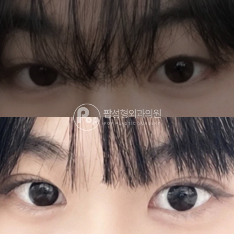 팝성형외과 쌍수 자연유착 눈성형 후기