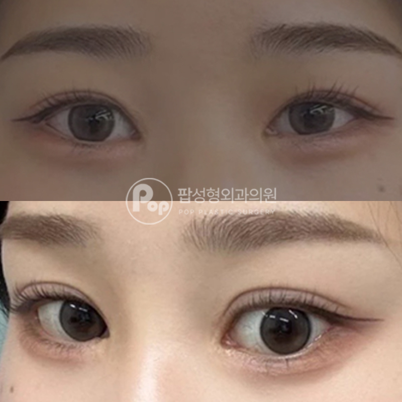 팝성형외과 짝눈 비대칭 눈재수술 2개월차 후기