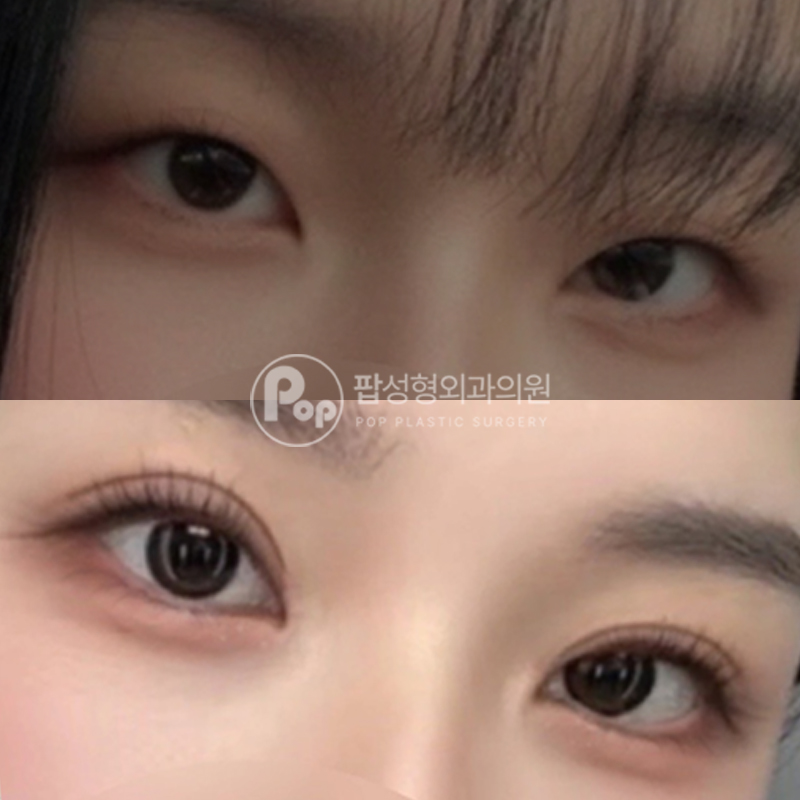 팝성형외과 세미아웃라인 쌍수 후기