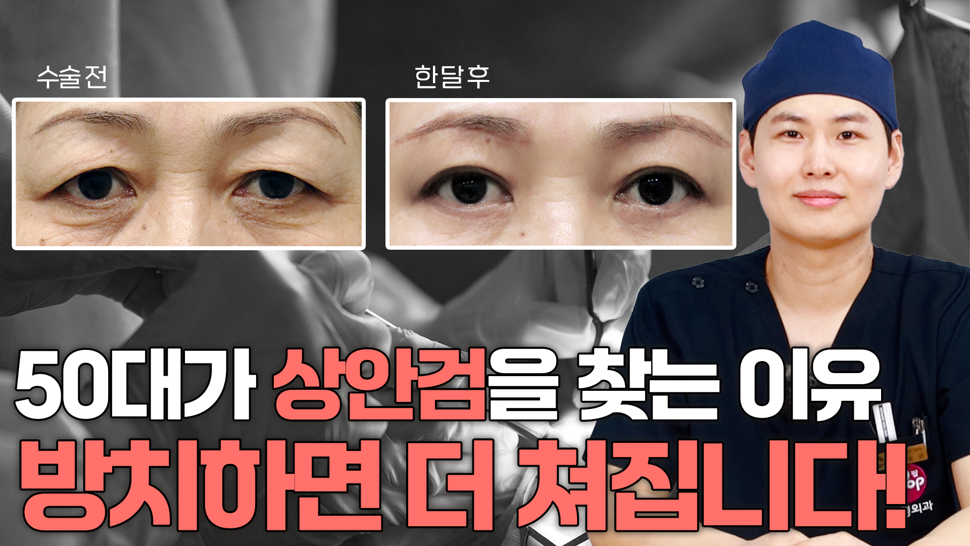 50대가 상안검을 찾는이유, 방치하면 더 쳐집니다!