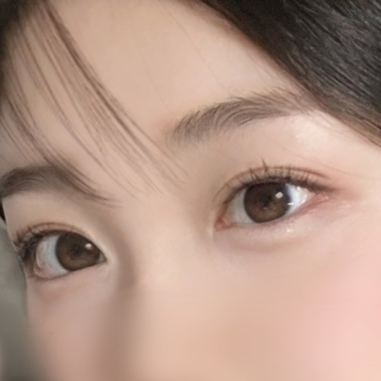 자연유착 + 트임 1개월차