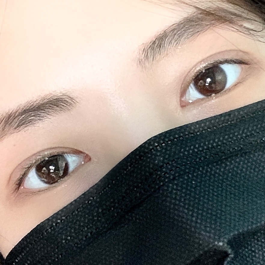 팝성형외과의원 김호준원장님께 수술받은지 2주차 후기입니다:)