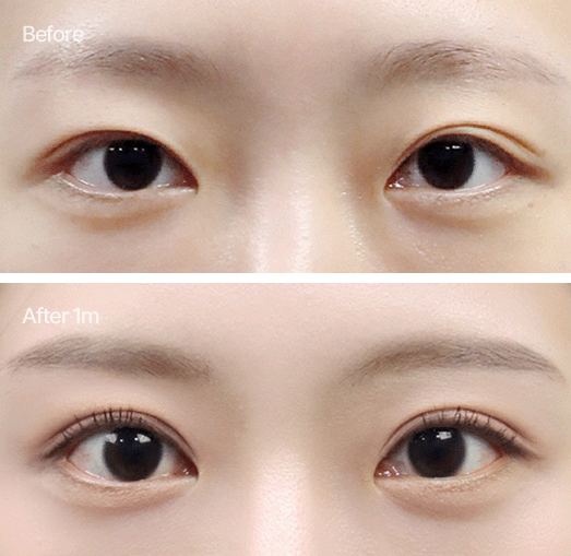양쪽 라인이 비대칭인 경우