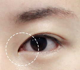 몽고주름 여부