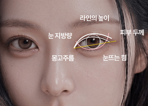 눈재수술 프로세스