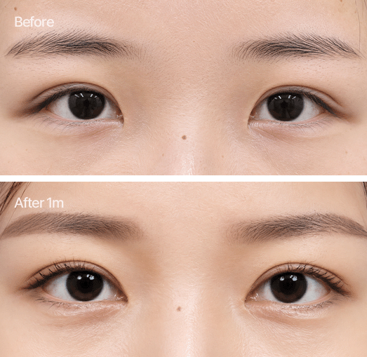늘어진 피부로 인한 소세지 쌍꺼풀