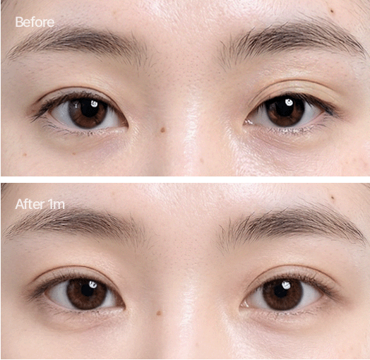 한쪽 눈이 풀린 경우