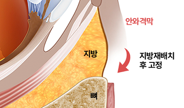 일반 눈밑지방재배치