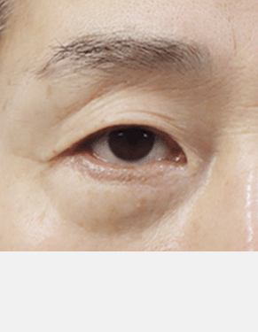 속눈썹이 눈을 찌르는 경우