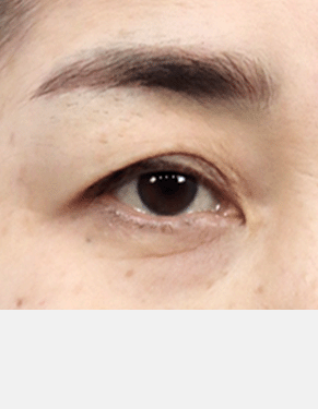 눈꼬리가 짓물려 눈물이 자주 고이는 경우