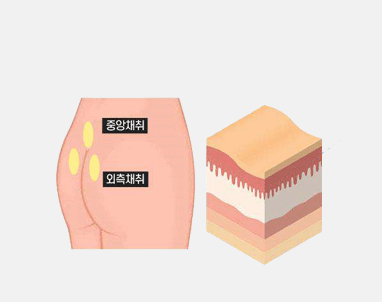 자가진피