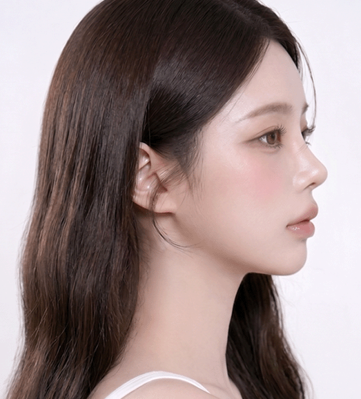 자가연골 코성형